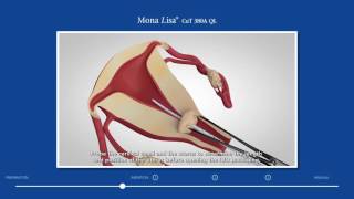 Mona Lisa CuT 380A QL Insertion Video [upl. by Aekerly734]