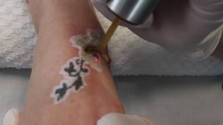 PicoWay Tattoo Removal [upl. by Gonagle]