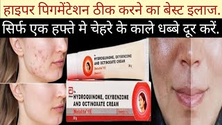 Melalite 15 cream ke Fayde Melalite 15 Cream Uses in Hindi Melalite skin cream [upl. by Initsed645]