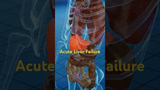 Acute Liver Failure What Triggers This LifeThreatening Condition liverdamage [upl. by Toddy]