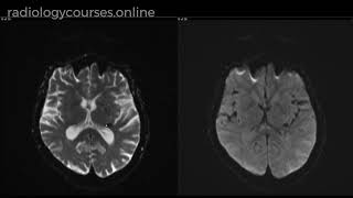 Diagnosing cavernoma when no Haem sequences are not available [upl. by Aloisius]