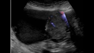 Ovarian mass that proved to be serous carcinoma ultrasound CTinterestingcases [upl. by Ludovico]