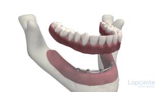 Prothèse complète sur implants  Centres dentaires Lapointe [upl. by Hildick]