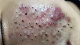 Big Cystic Acne Blackheads Extraction Blackheads amp Milia Whiteheads Removal Pimple Popping  695 [upl. by Thorsten]