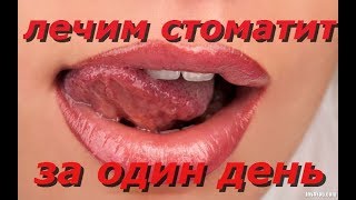 Как вылечить стоматит за один день в домашних условиях [upl. by Xxam]