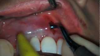 Treatment of Gum Recession by VISTA technique CaseII [upl. by Parrie31]