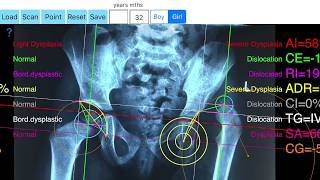 Hip dysplasia App tutorial video how to measure with App in ipad or iphone [upl. by Eznyl478]