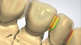 7 unit PFM with Metal Linguals Guide Planes Cingulum and Distal rest seat [upl. by Delsman]