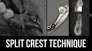 Lateral Augmentation of the Alveolar Ridge using Split Crest Technique [upl. by Sadick60]