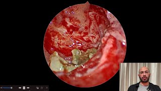 Isolated maxillary sinusitis \ Fungal ball \ FESS [upl. by Yrreb]