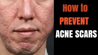 ACNE SCARS  how to prevent [upl. by Apul]