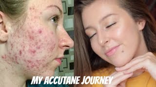 MY ISOTRETINOIN ACCUTANE JOURNEY  BEFORE AND AFTER PHOTOS [upl. by Yessac]