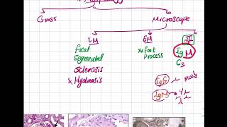 Focal Segmental amp Membranoproliferative GN [upl. by Enaek]