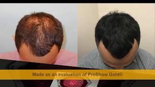 Best laser hair growth device  Laser Treatments for Thinning Hair [upl. by Tletski]