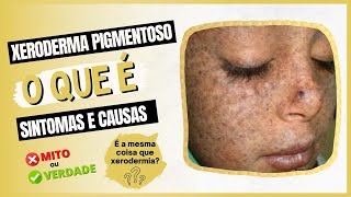 Xeroderma Pigmentoso  O que é sintomas e causas [upl. by Publias454]