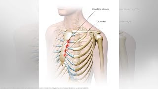 What You Need to Know About Tietze Syndrome  Tita TV [upl. by Cathie]