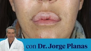 Corpore Sano Cómo sacar los granulomas en los labios [upl. by Zwick]