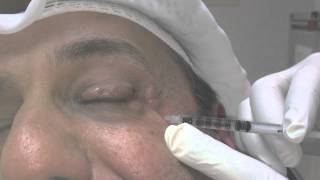 Blepharospasm and Botox Treatment [upl. by Holcomb429]