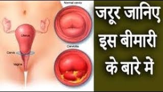 गर्भाशय ग्रीवा शोथ │ यौन संक्रमण रोग │ Cervicitis Symptoms amp Causes [upl. by Kern719]