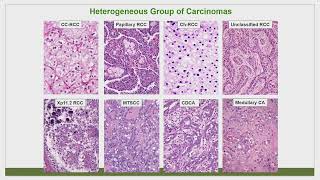 A Diagnostic Approach to the many Subtypes of Renal Cell Carcinoma by Michelle S Hirsch MD PhD [upl. by Perseus269]