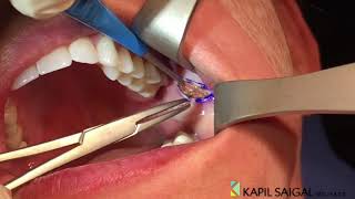 AWAKE Buccal Fat removal [upl. by Yasmeen]