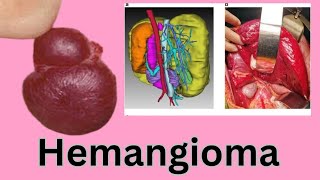 Liver Hemangioma Causes Symptoms Diagnosis amp Treatment [upl. by Marshal]