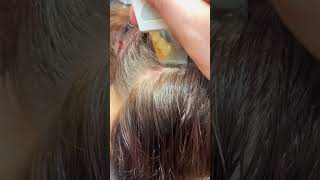 Scalp Treatment for Eczema [upl. by Rance]