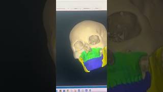 Best 3 D Planning before Bimax Orthognathic Surgery at Richardsons Face Hospitals [upl. by Allista371]