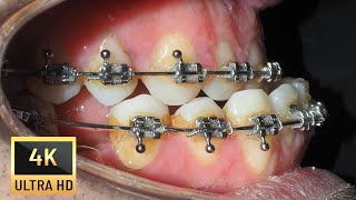 UNDERBITE in adults❗Braces time lapse [upl. by Gnah]