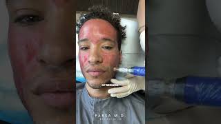 Microneedling with PRP for Acne Scars  Kami Parsa MD skincare acnescars [upl. by Ilan625]