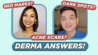 How to treat ACNE SCARS amp ACNE MARKS Dermatologist Answers Filipino  Jan Angelo [upl. by Nosmoht]