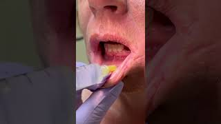 Dental Abscess Incision and Drainage in 60 seconds [upl. by Nnahs]