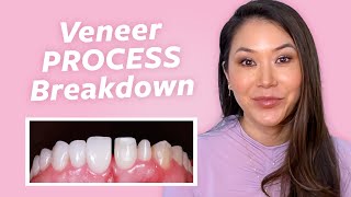 Veneers Process StepByStep  Joyce the Dentist [upl. by Stinky]