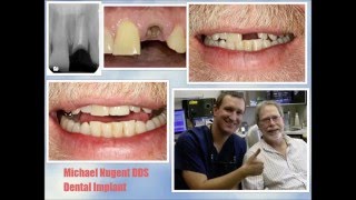 Osseointegration  How Dental Implants fuse to bone [upl. by Eltsryk]