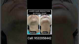 Treat unwanted facial hair with LASER HAIR REDUCTION laserhairremoval facialhairremoval pcod [upl. by Eiveneg]