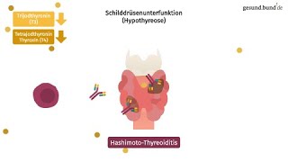 Welche häufigen Schilddrüsenerkrankungen gibt es [upl. by Ledoux]