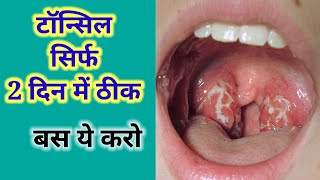 टॉन्सिल सिर्फ 2 दिन में ठीकTonsil ko kaise thik karenTonsil treatmentTonsil ka ilaj [upl. by Asalocin]