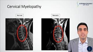 Cervical Myelopathy  What is it How can we treat it [upl. by Philippa]