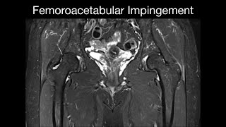 Femoroacetabular Impingement [upl. by Rennat847]