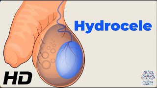 Dealing with Hydrocele Understanding the Condition and How to Manage It [upl. by Miun343]