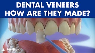 Veneers  How are they made Preparation and placement of cosmetic dentistry veneers © [upl. by Volpe]