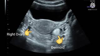 Left ovarian dermoid cyst [upl. by Derina]