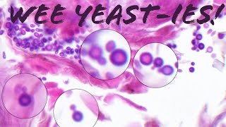 Yeast Skin Fungus MalasseziaPityrosporum incidental in actinic keratosis  not yeast infection [upl. by Neville]