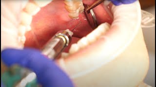 Inferior Alveolar Nerve Block Demonstration and Overview 4K [upl. by Bumgardner]