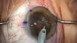 Modern Cataract Surgery Alcon ReSTOR IOL with LRI [upl. by Feriga653]