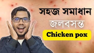 জলবসন্ত বা চিকেন পক্স Chicken pox হলে করনীয় লক্ষণ চিকিৎসা [upl. by Alegre522]