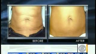 BTL Exilis TV Show Video 1 CBS News with Dr Jeanine Downie [upl. by Schulein565]