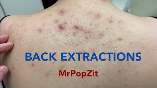 Tons of blackheads on the back Acne extractions Blackheads and whiteheads Mining pore dirt [upl. by Freytag]