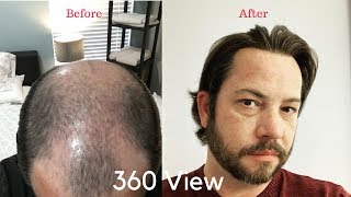 Full 360 View Of My Hair And A Great Hair Day With A Hair Replacement or Hair System [upl. by Eiblehs]