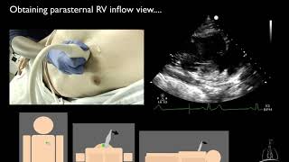 05 Right ventricular inflow amp outflow views [upl. by Heinrich]